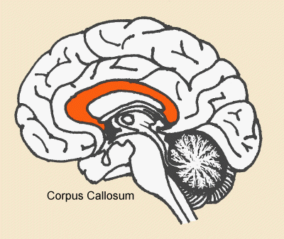Original midline cross-section of the brain. The corpus callosum is highlighted as an orange curved band above the central structures, with a label reading Corpus Callosum.